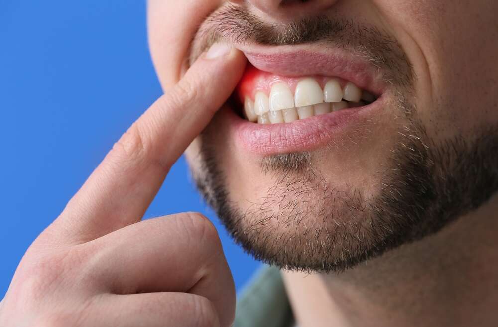 Emergency Dental Care: Taking Action Against Tooth Abscesses