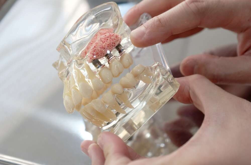The 101 on Dental Bone Grafts