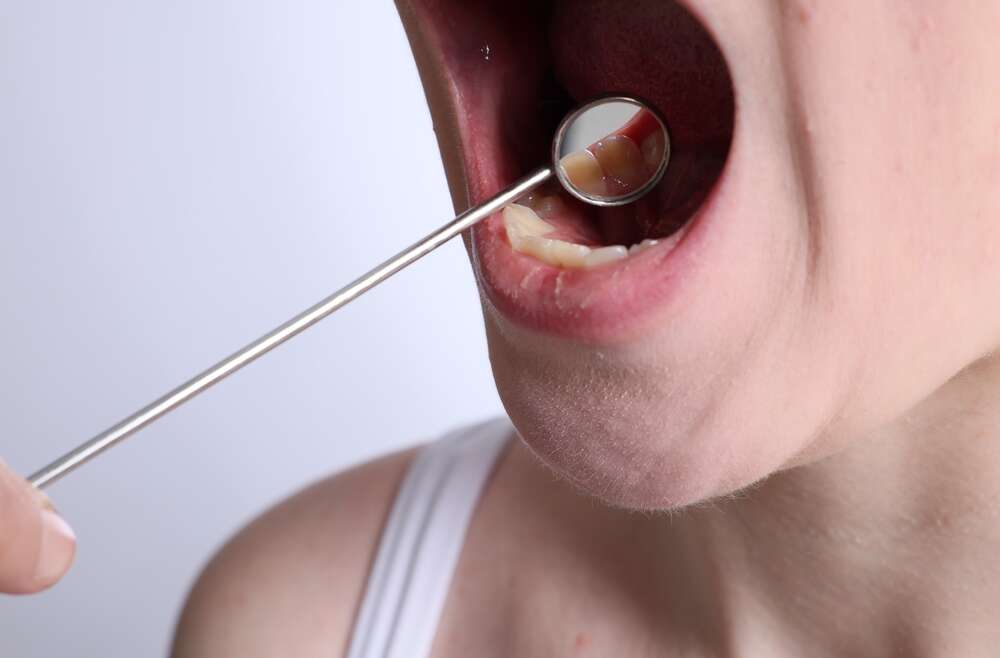 The Importance of Regular Screenings: How Dentists Help Detect Oral Cancer Early