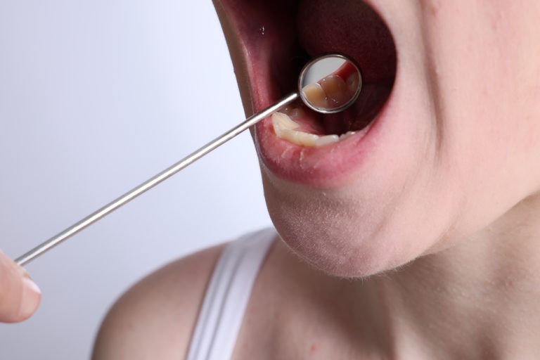 The Importance of Regular Screenings: How Dentists Help Detect Oral Cancer Early