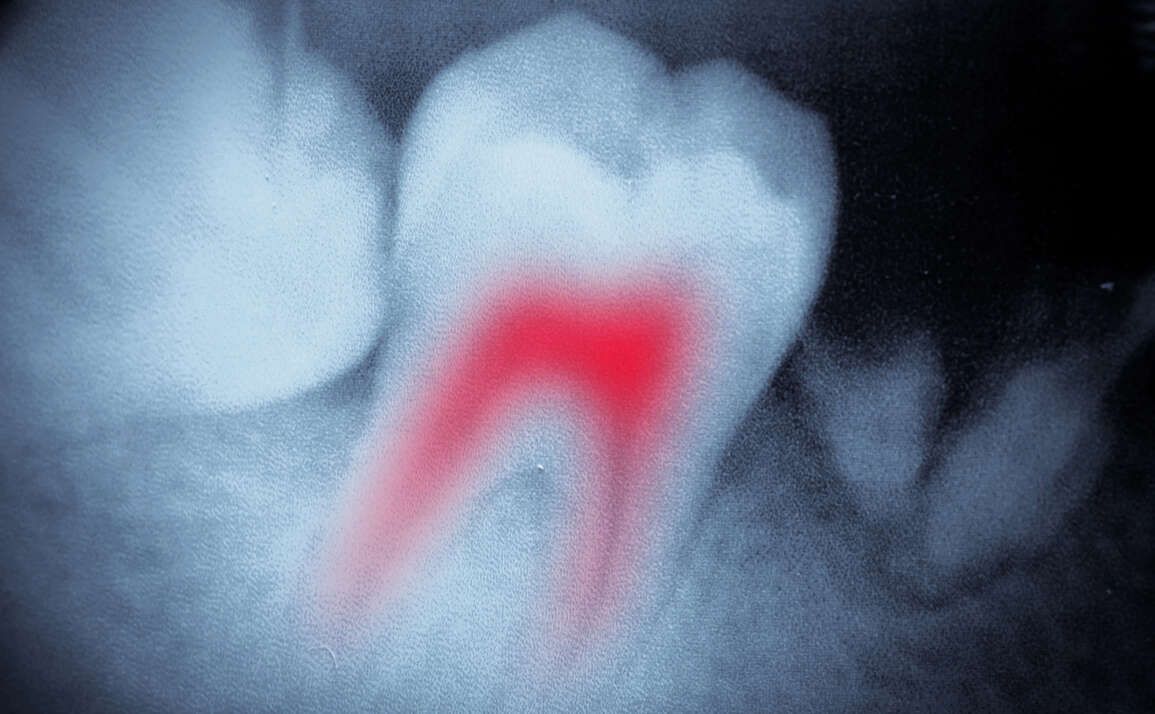 Root Canal Awareness – Recognizing the 7 Warning Signs That Could Save Your Tooth