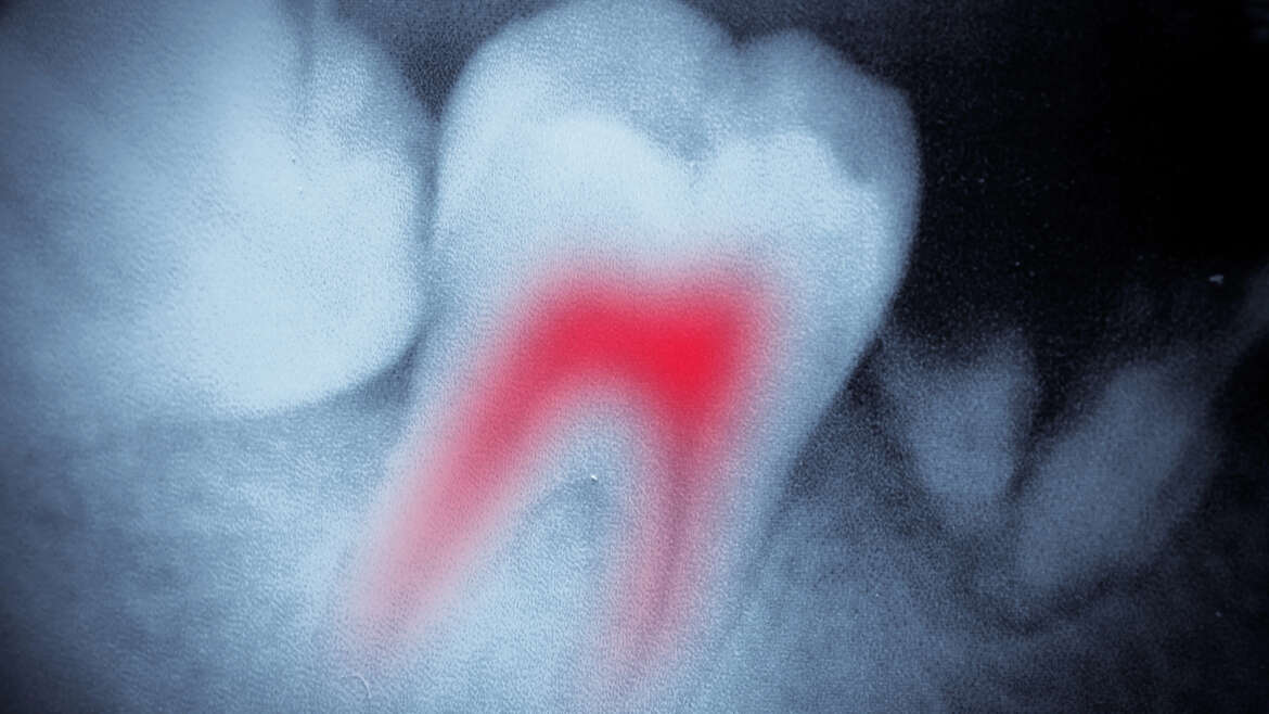 Root Canal Awareness – Recognizing the 7 Warning Signs That Could Save Your Tooth