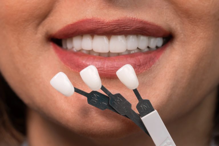 The Art of Smile Design: Veneers Tailored for Individual Faces