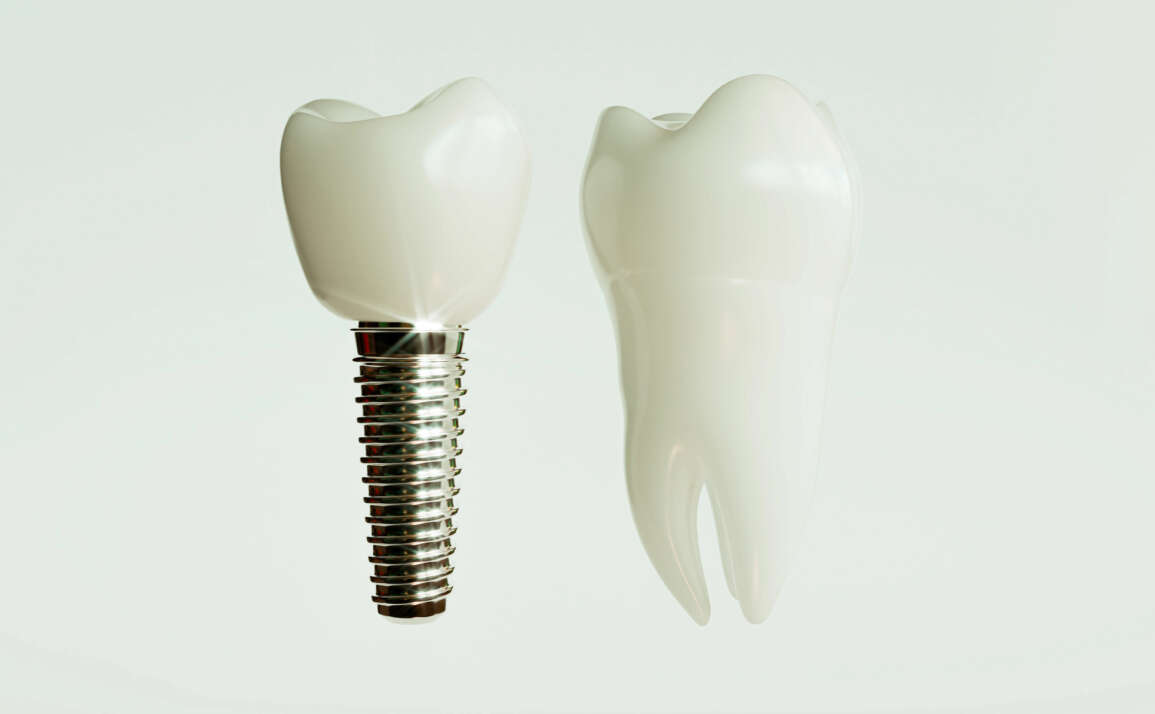 From Consultation to Crown: Ashraf Dentistry Breaks Down Dental Implants