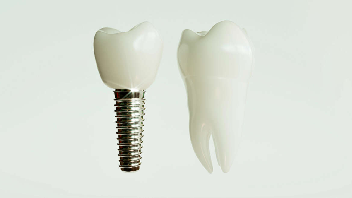 From Consultation to Crown: Ashraf Dentistry Breaks Down Dental Implants