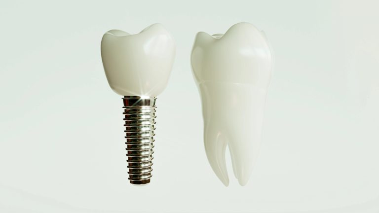 From Consultation to Crown: Ashraf Dentistry Breaks Down Dental Implants