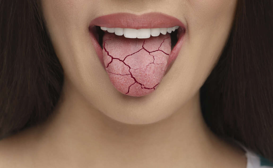 Dry Mouth Remedies: A Waterloo Family Dental Perspective from Ashraf Dentistry