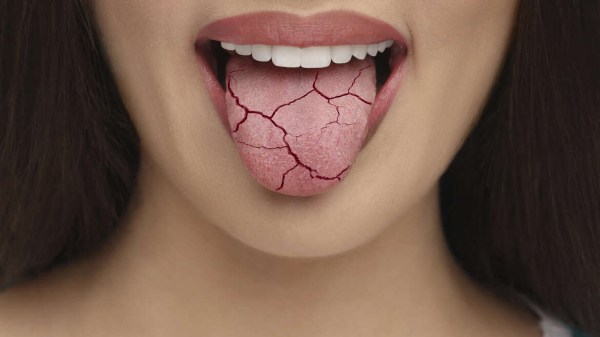 Dry Mouth Remedies: A Waterloo Family Dental Perspective from Ashraf Dentistry