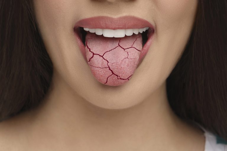 Dry Mouth Remedies: A Waterloo Family Dental Perspective from Ashraf Dentistry