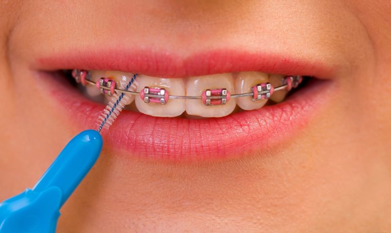 An Orthodontic Trend We Do Not Recommend