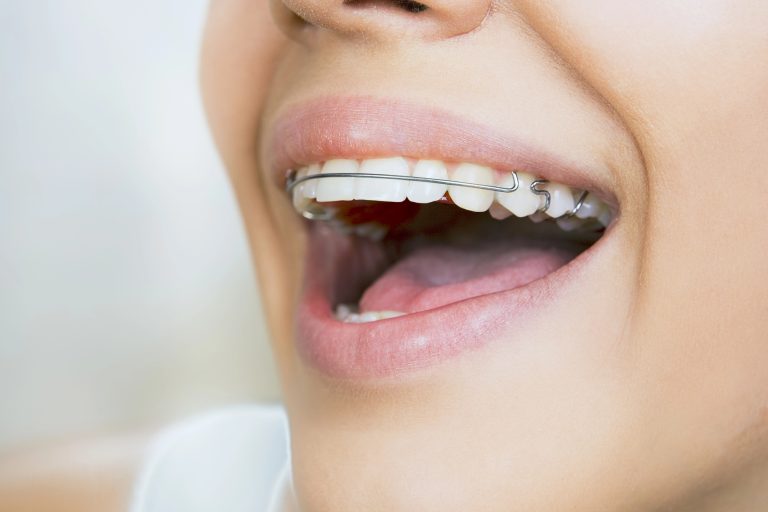 The Unexpected Benefits of Wearing a Retainer: Posture, Balance, and Bite Harmony