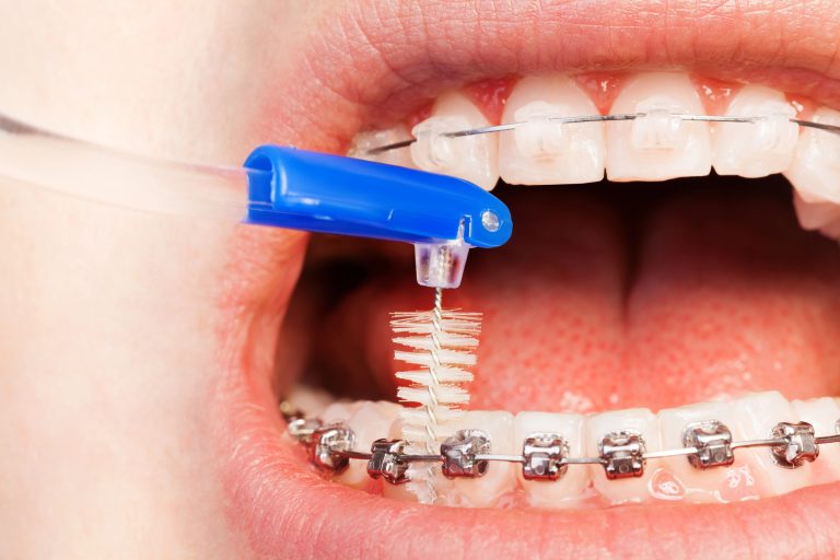 Essential Oral Care Tools to Maintain Orthodontic Treatment