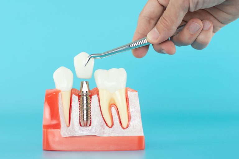 Understanding Dental Implants and Osteoporosis: Guidance from a Waterloo Dentist
