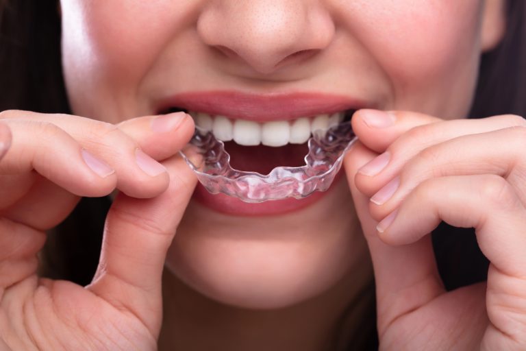 Clear Aligners 101: Are They the Right Choice for You?