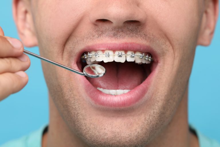Orthodontics and Periodontal Health: Keeping Your Gums Healthy During Treatment