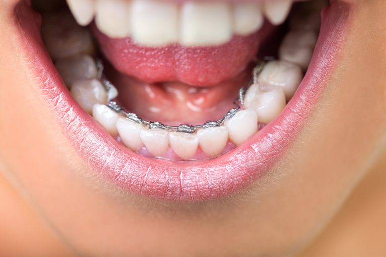 Invisible Braces: The Aesthetics and Practicality of Lingual Orthodontics