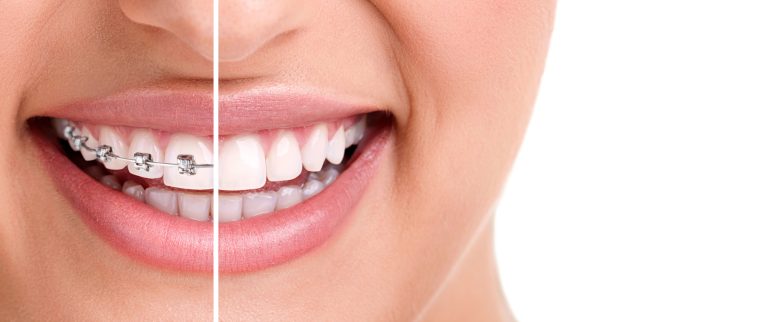 Customizing Your Orthodontic Experience in Toronto