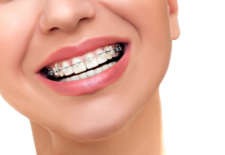 The Psychological Impact of Orthodontic Treatment: Boosting Confidence and Self-Esteem