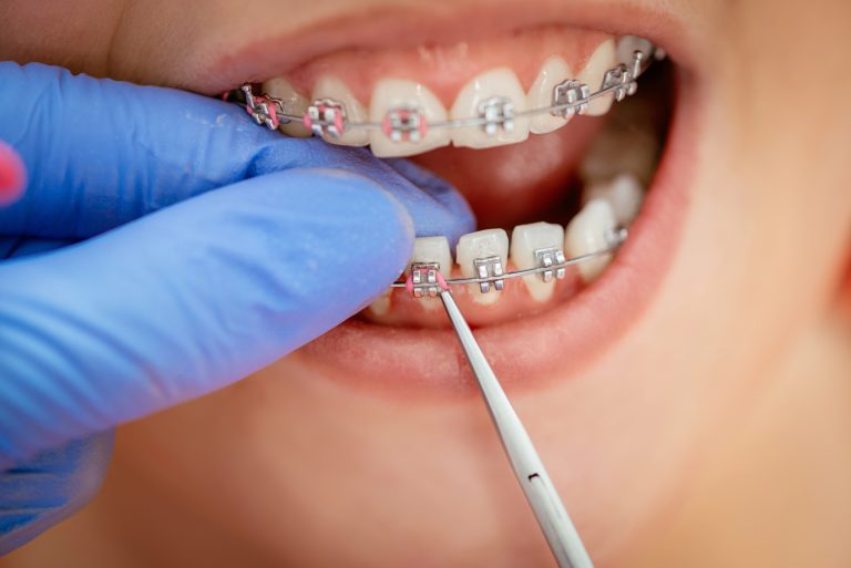 Orthodontic Emergencies: How to Handle Braces Discomfort and Common Issues