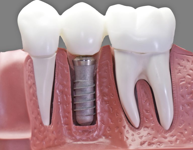 Dental Implants In Waterloo: Why Timing Is About Biology