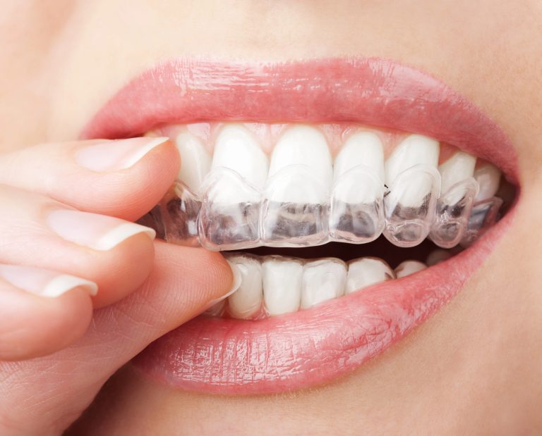 Spring Reset: Are Clear Braces Toronto Right for You?