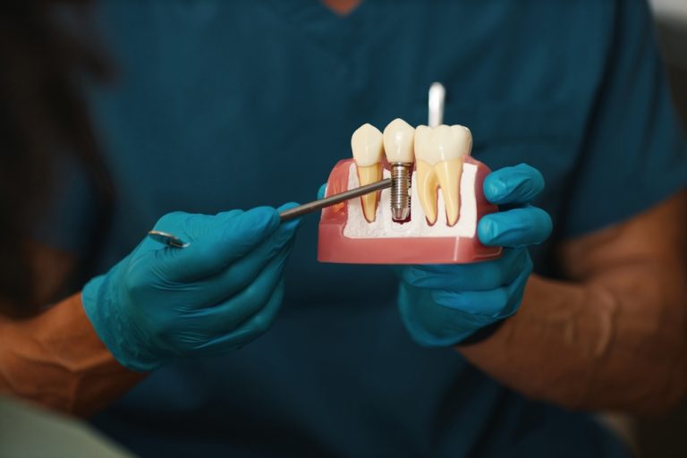 Dental Implants 2.0: What’s New for Longer-Lasting Results in 2026