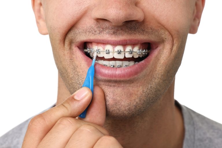 How to Support Your Orthodontic Treatment with Strong Oral Hygiene Habits