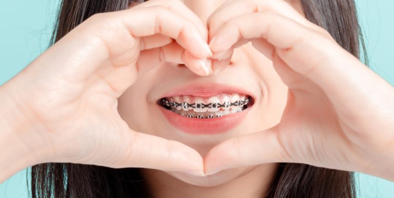 Why Braces in Toronto Are Still a Top Choice for Families