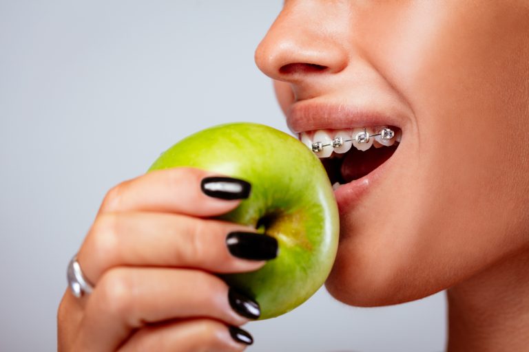 Orthodontic Care in Toronto: A Complete Guide to Eating with Braces