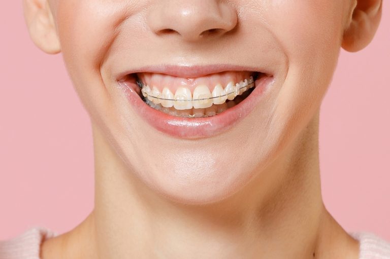The Practical Beauty of Clear Braces Toronto