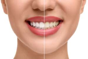Teeth Whitening