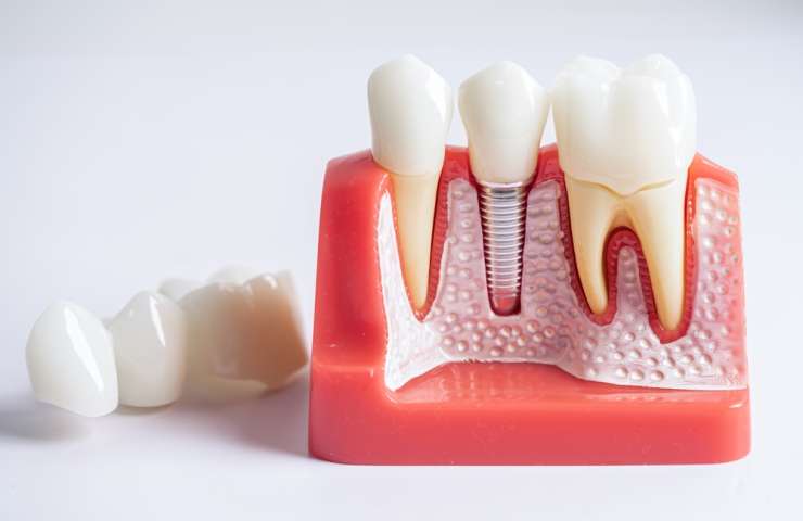 Dental Implants: Candidate Eligibility, Health and the Factors That Matter
