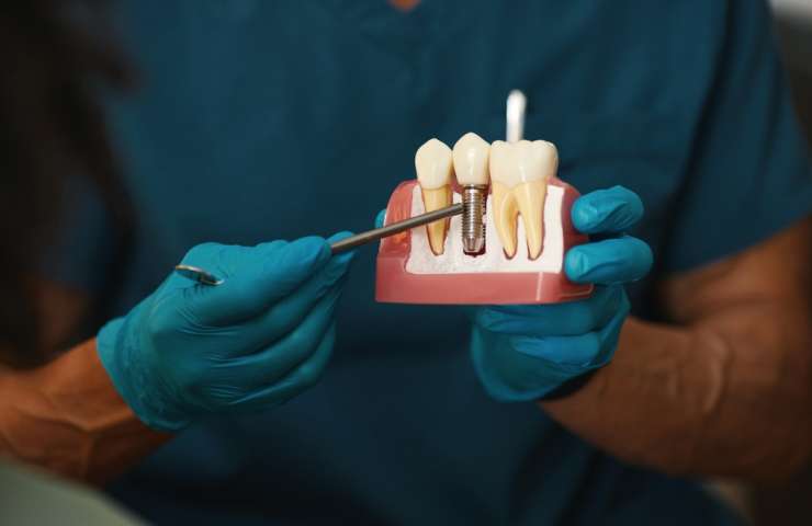 Beyond Appearance: Five Benefits of Dental Implants in Waterloo